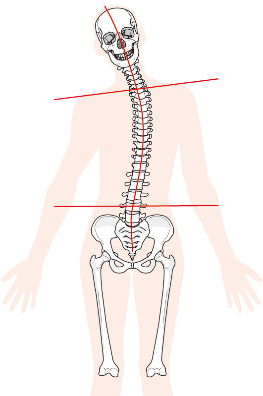 脊柱管狭窄症への当院のアプローチは？