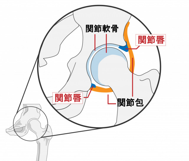 変形性股関節症とは?